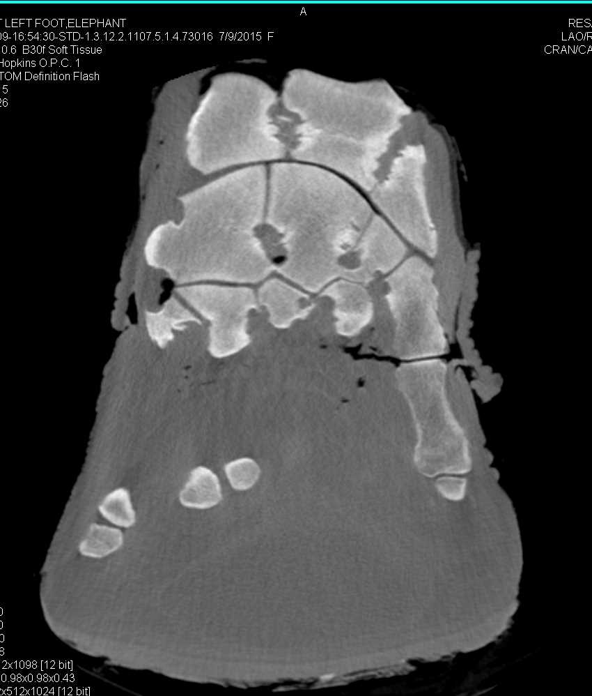CT of Elephants Feet - CTisus CT Scan