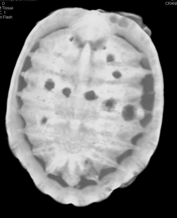 Multiple Areas of Infection in a Turtle in his shell - CTisus CT Scan