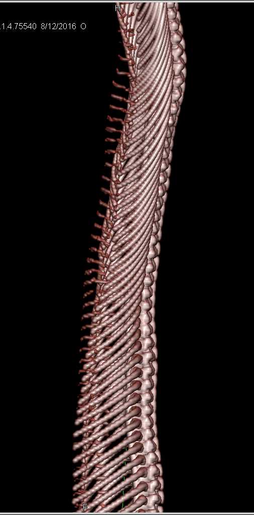 CT of a Boa Constrictor Who Has Lots of Ribs - CTisus CT Scan