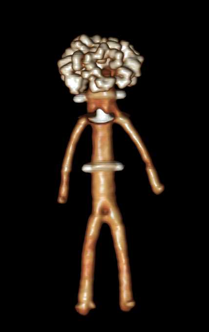 CT of Ancient Art - CTisus CT Scan