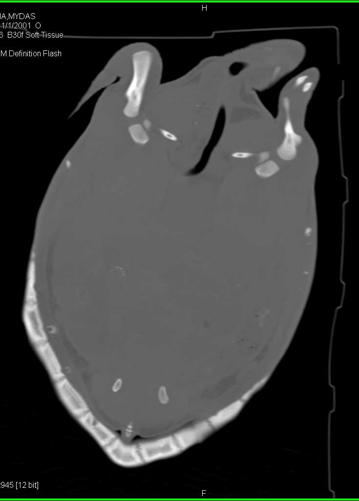3D imaging of the Turtles Shell and Bones - CTisus CT Scan