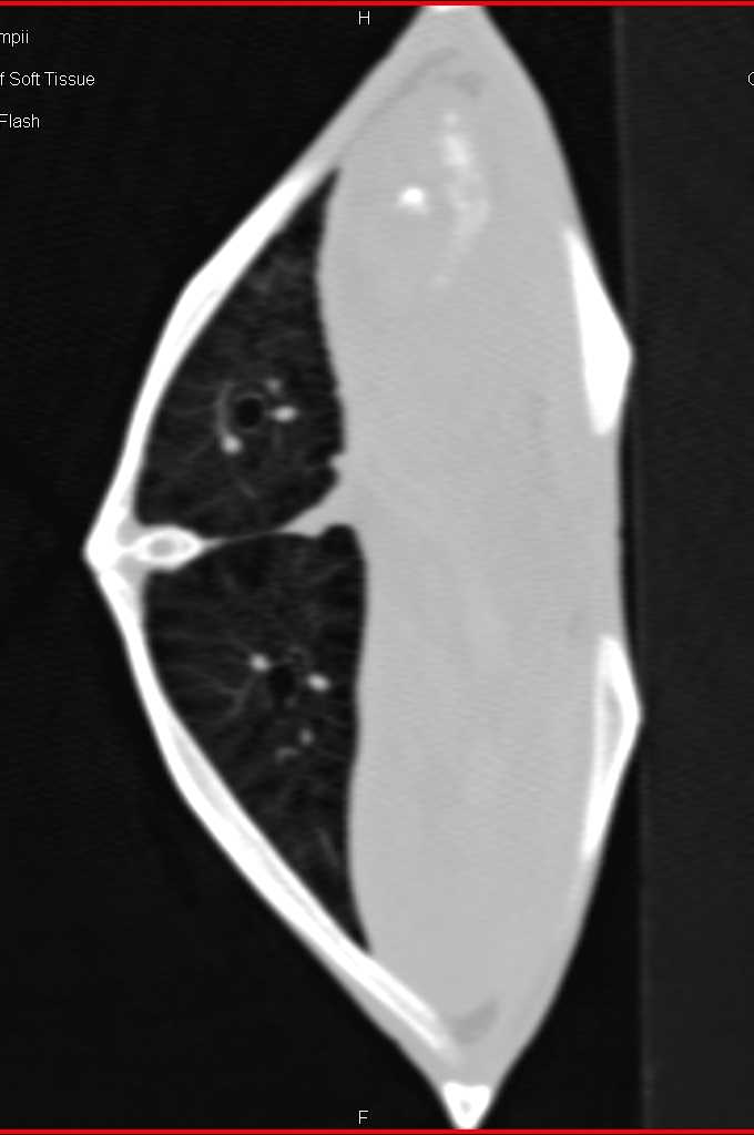 Turtle CT without Ascess - CTisus CT Scan