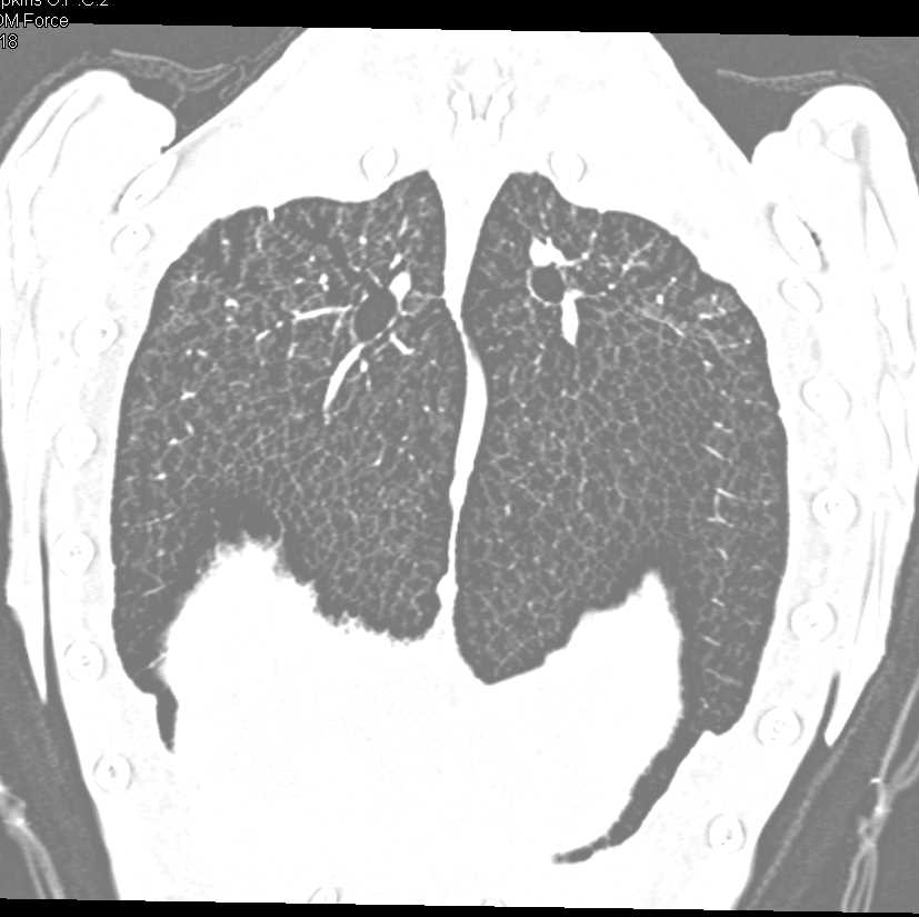 CT Turtle with Nice Lung 3D - CTisus CT Scan
