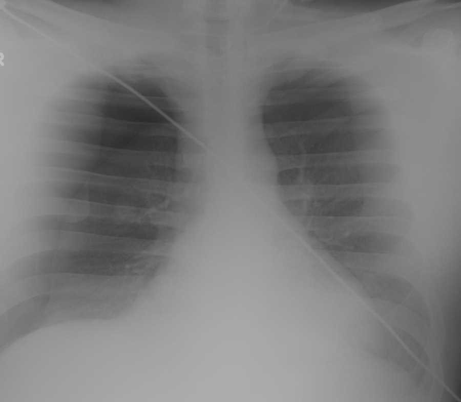 Bilateral Pneumothoraces after Stabbing - CTisus CT Scan
