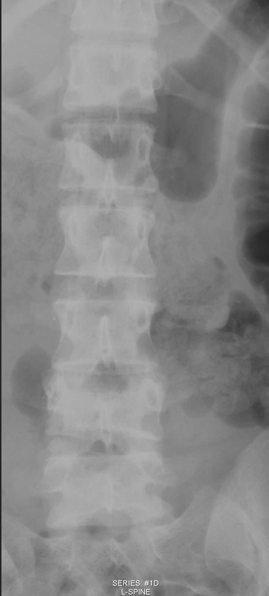 Burst Fracture L4 on X-ray and CT - CTisus CT Scan