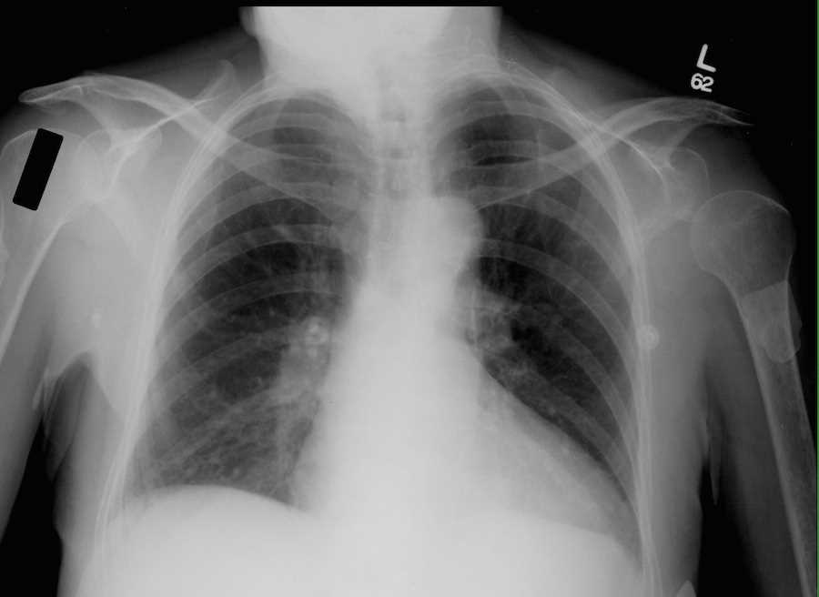 Drooping Shoulder on Chest X-ray - CTisus CT Scan