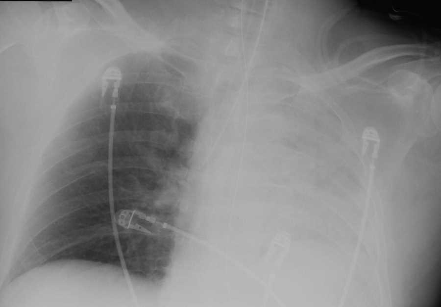 Endotracheal Tube in Right Mainstem Bronchus - CTisus CT Scan