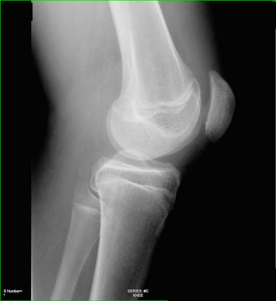 Fracture of Patella on X-ray - CTisus CT Scan