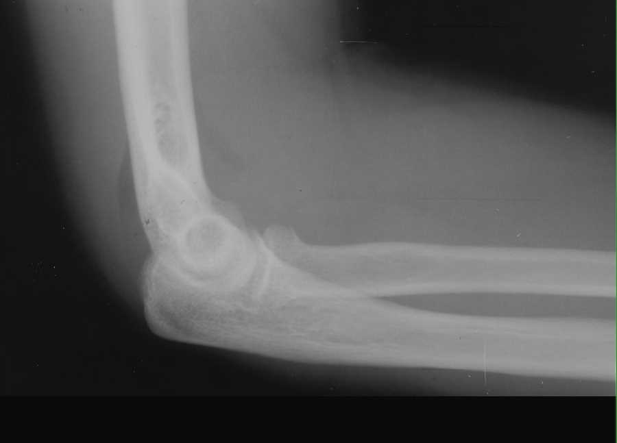 Fracture Radial Head on X-ray - CTisus CT Scan