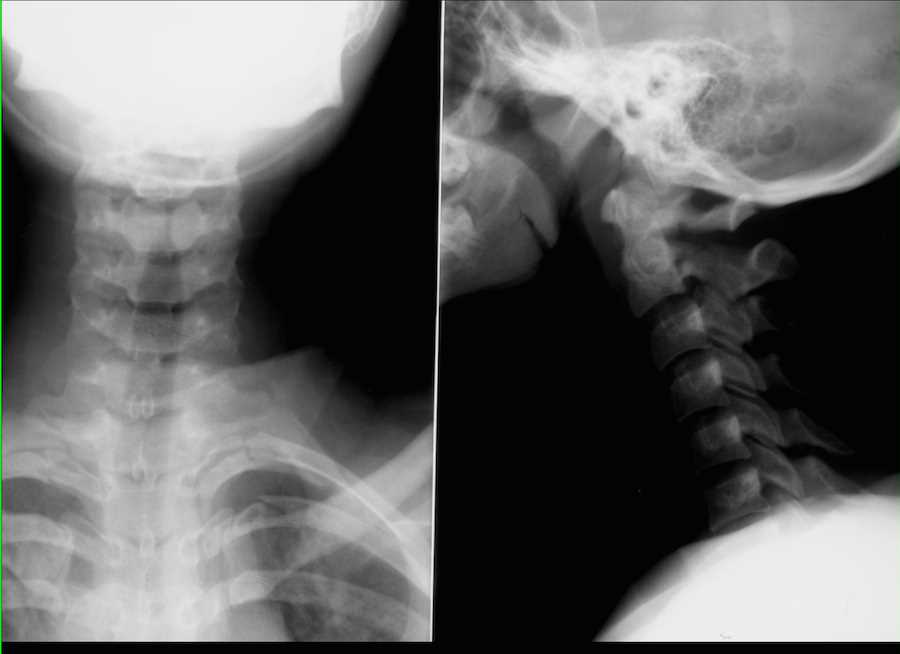 Hangman's Fracture on X-ray - CTisus CT Scan