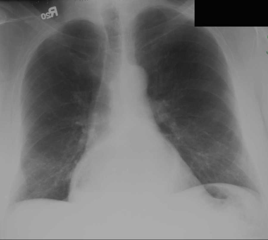 Hiatal Hernia on chest X-ray - CTisus CT Scan