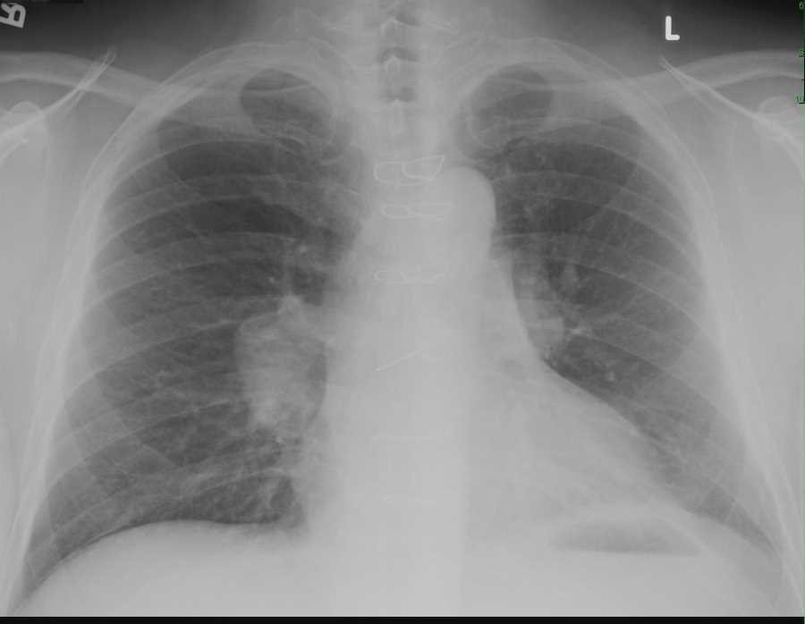 Hiatal Hernia On Chest X Ray X Rays Case Studies Ctisus Ct Scanning