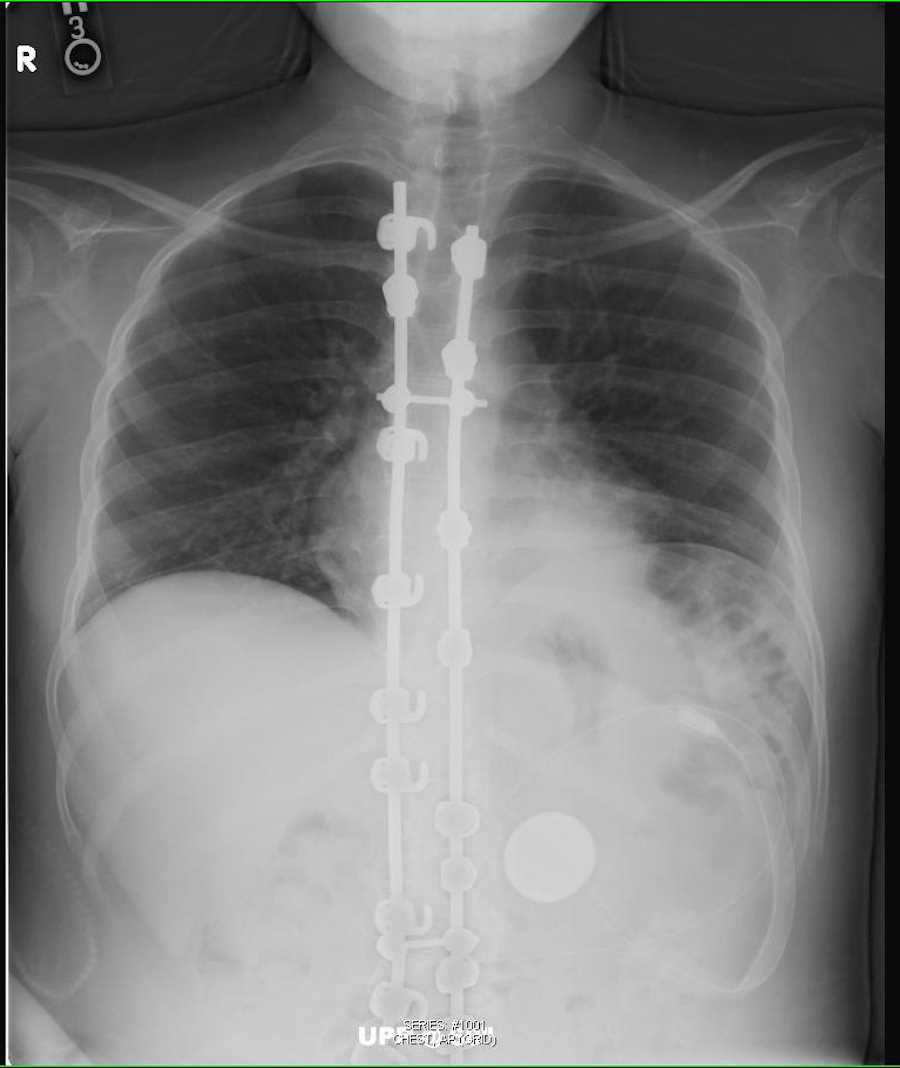 Left Lower Lobe Pneumonia - CTisus CT Scan