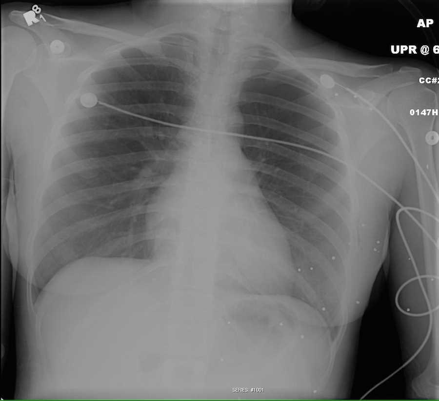 Left Pneumothorax after Birdshot - CTisus CT Scan