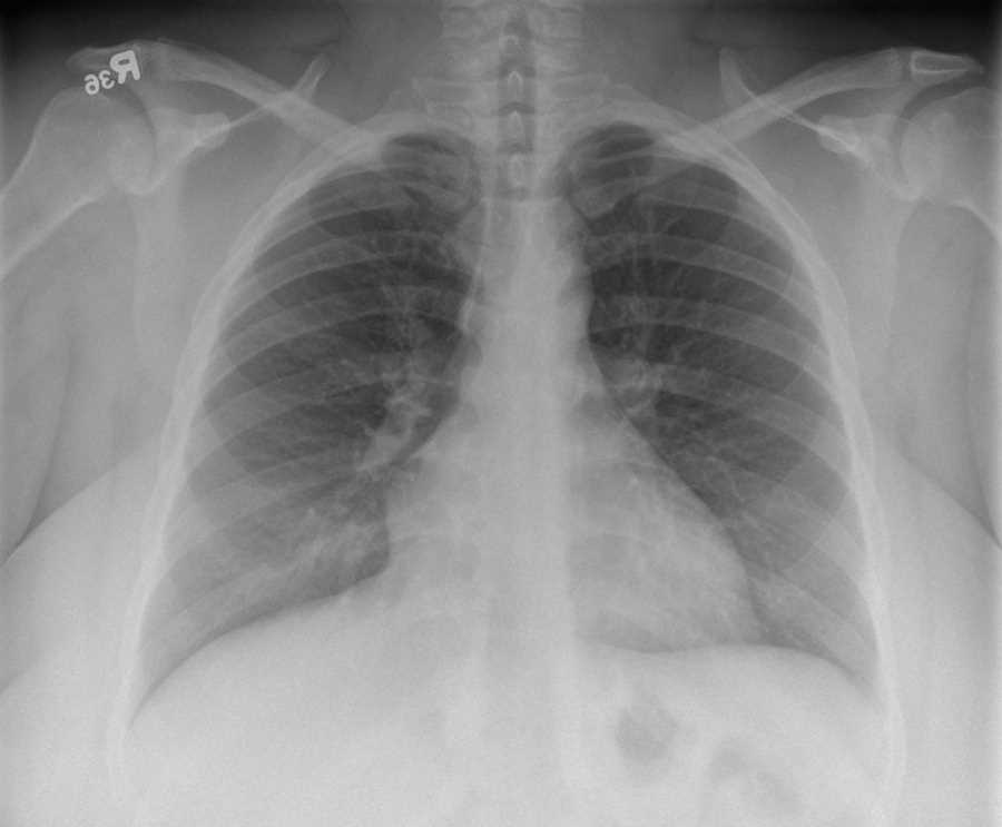 Normal Chest PA and Lateral - CTisus CT Scan
