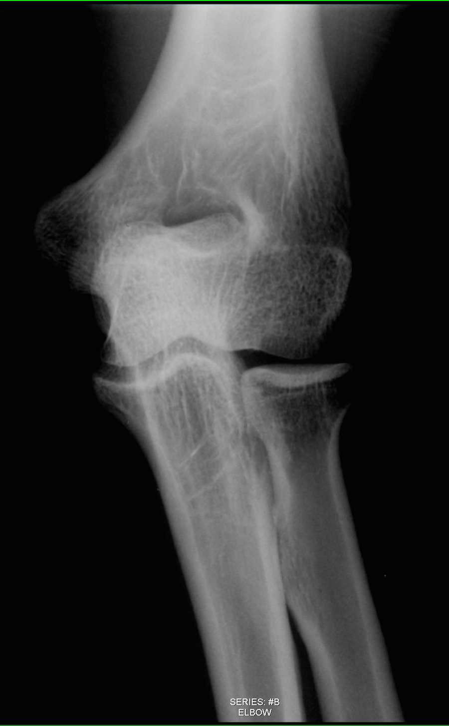 Normal Elbow on X-ray - CTisus CT Scan