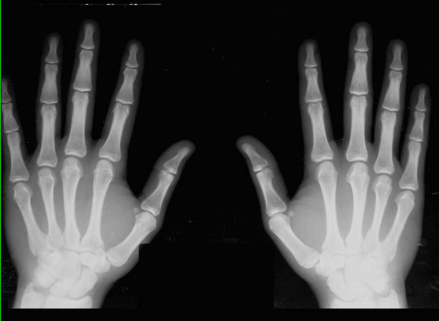 Normal Hands on X-ray - CTisus CT Scan