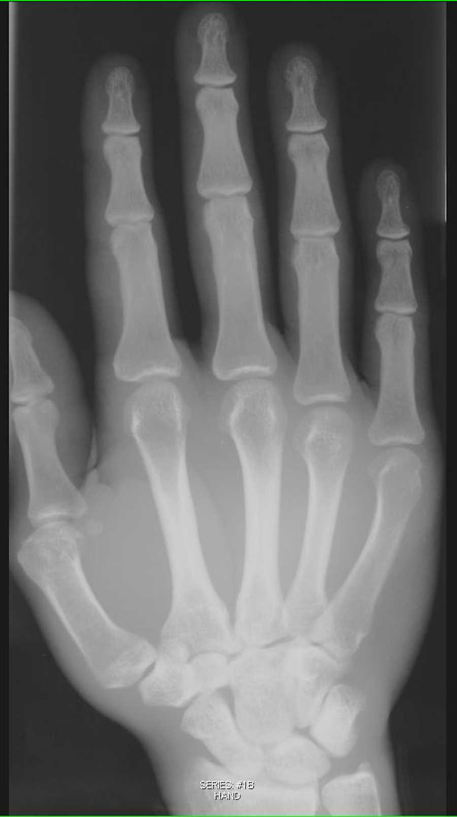 X-ray Hand with soft tissue swelling - CTisus CT Scan