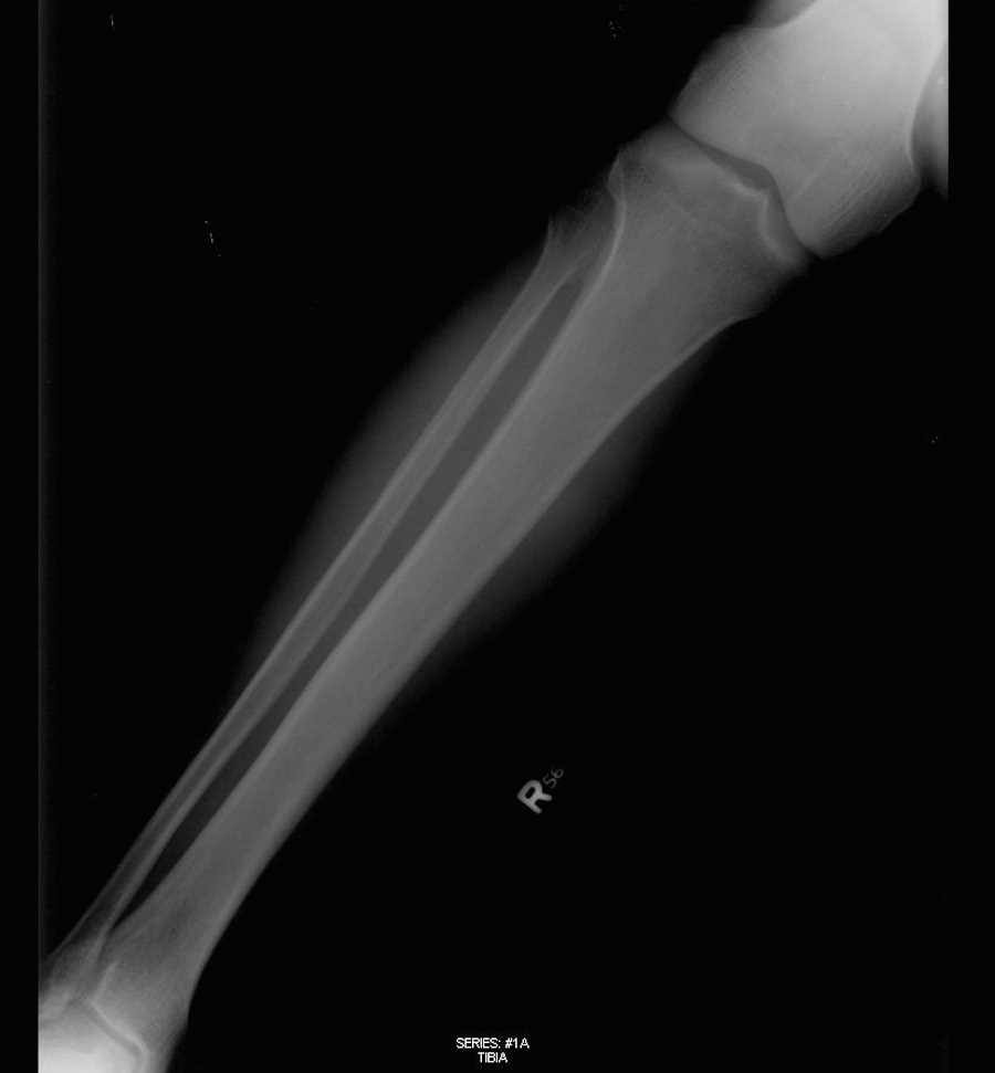 Normal X-ray Lower Extremity - CTisus CT Scan