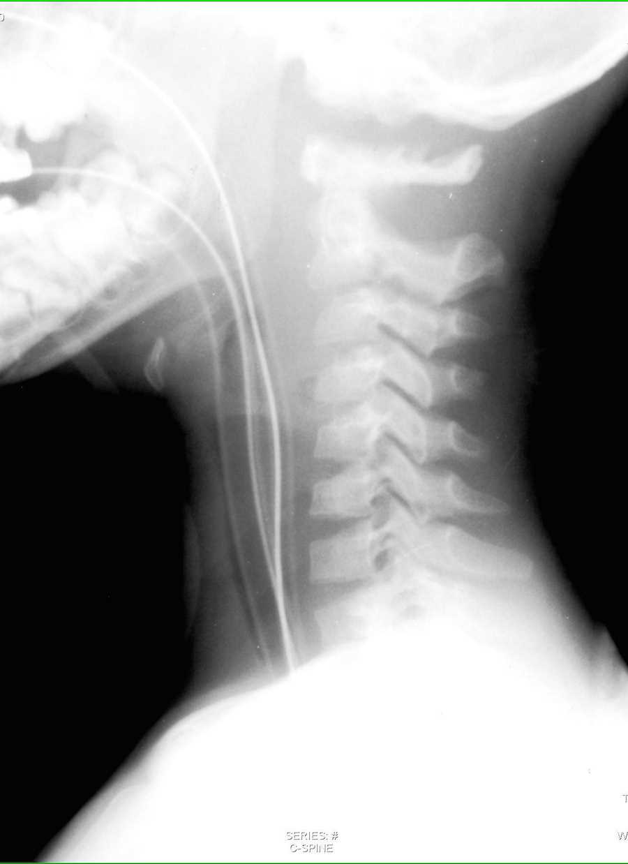 Occiput-C1 Separation on X-ray - CTisus CT Scan