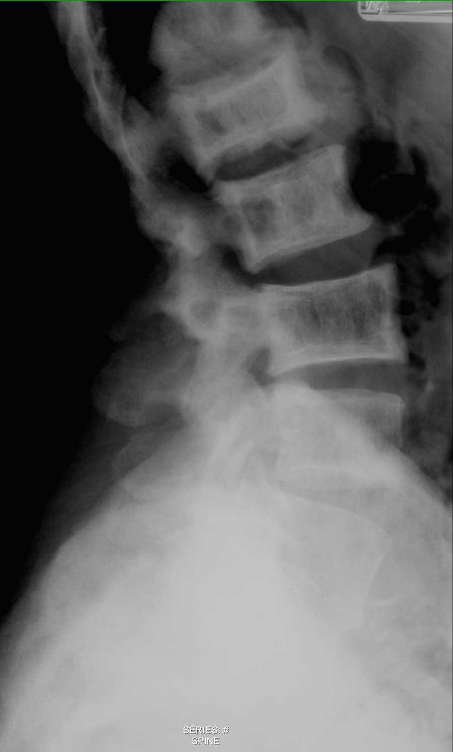 Paget's Disease of the Lumbar Spine on X-ray - CTisus CT Scan