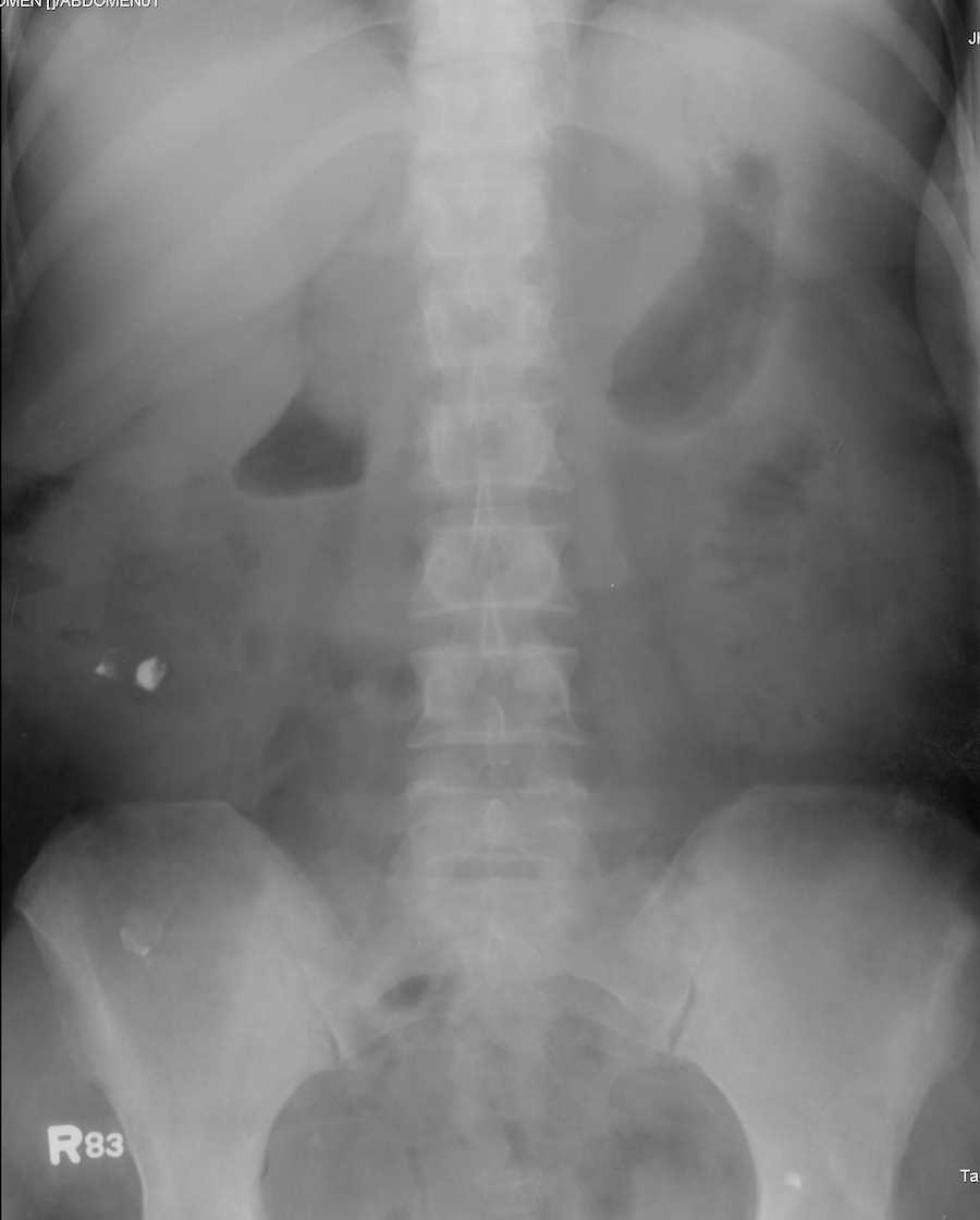 Polycystic Kidney Disease on Abdominal X-ray - CTisus CT Scan