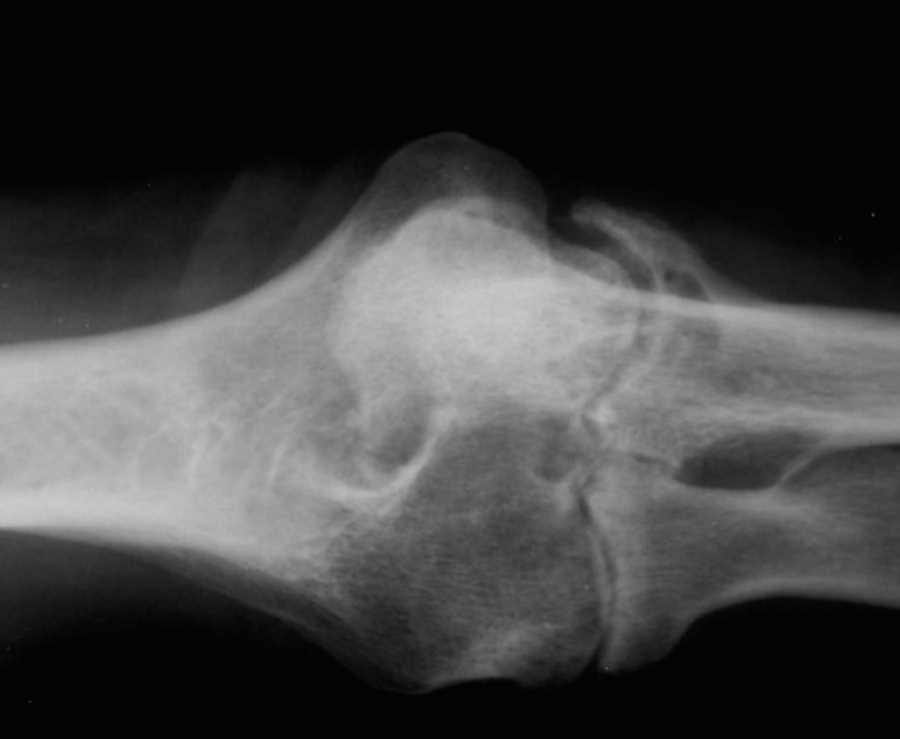 Rheumatoid Arthritis of Elbow on X-ray - CTisus CT Scan