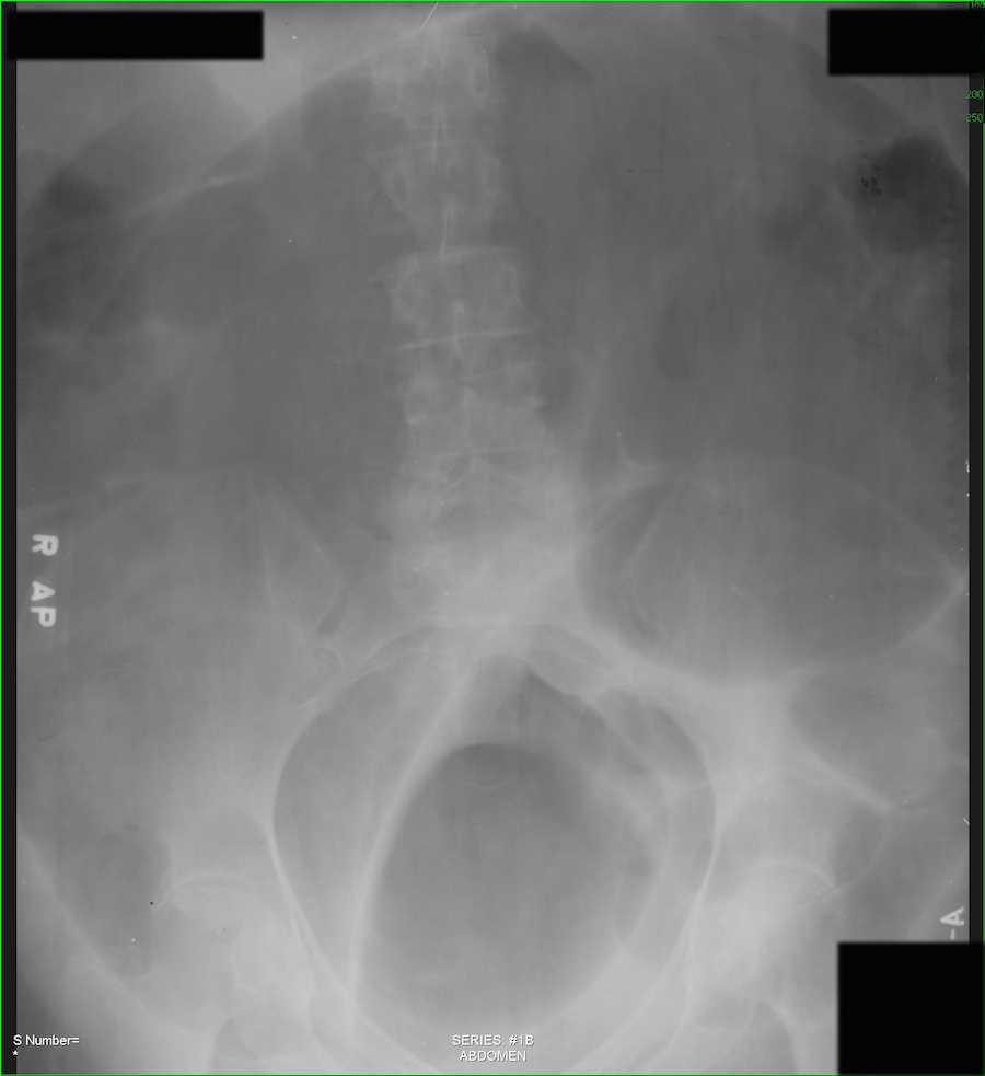 Sigmoid Volvulus on Abdominal X-ray - CTisus CT Scan