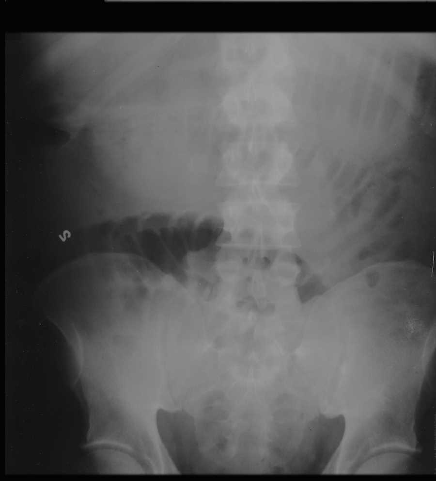 Small Bowel Obstruction on X-ray - CTisus CT Scan