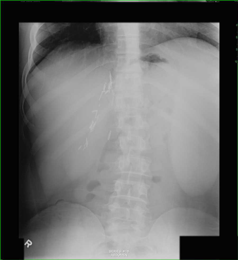 Splenomegaly on Abdominal X-ray - CTisus CT Scan