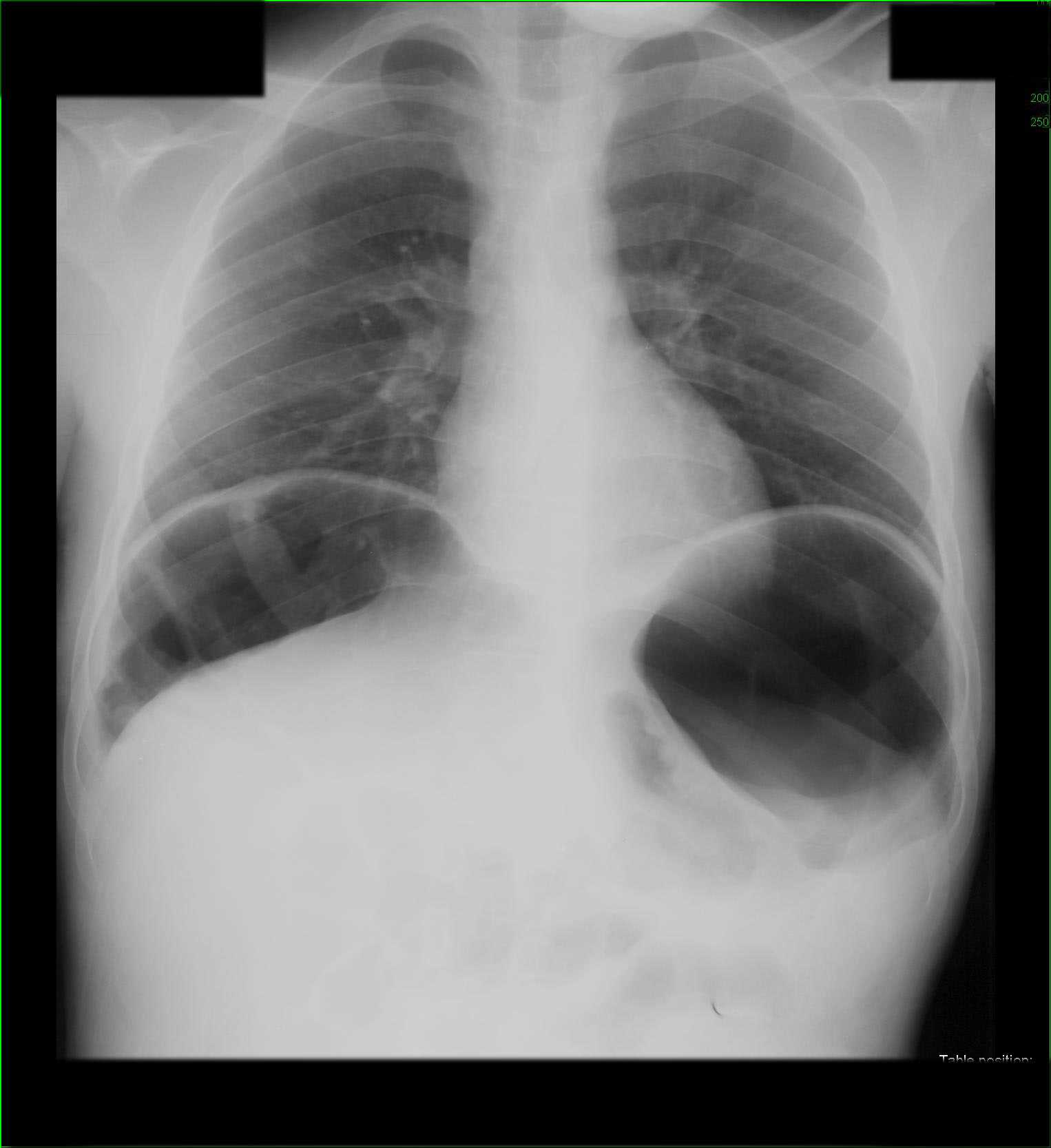 Interposition of colon under right Hemidiaphragm on X-ray - CTisus CT Scan