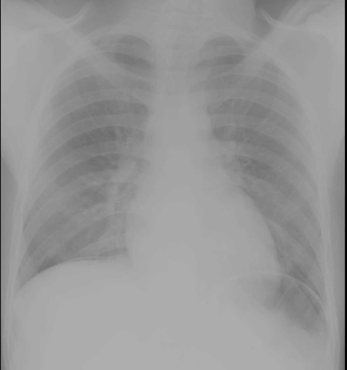 Pneumoperitoneum from Perforated Duodenal Ulcer on X-ray - CTisus CT Scan