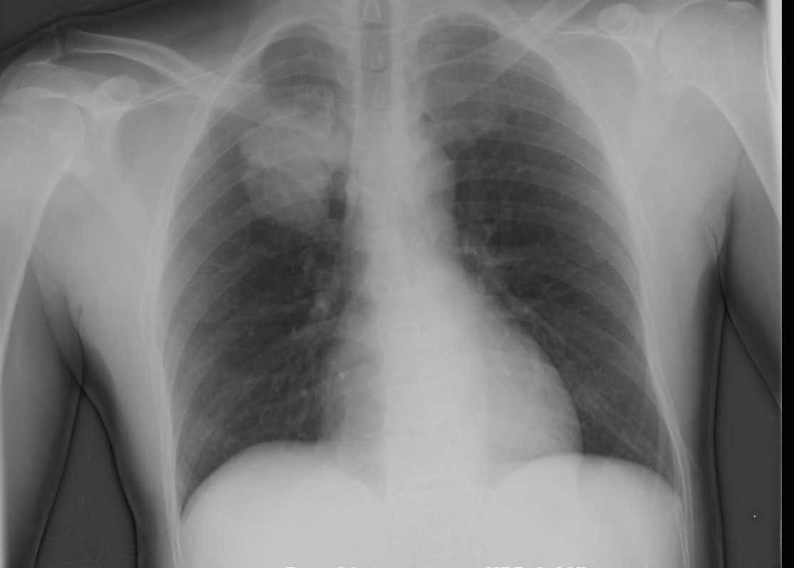 Right Upper Lobe Lung Cancer on X-ray and CT - CTisus CT Scan