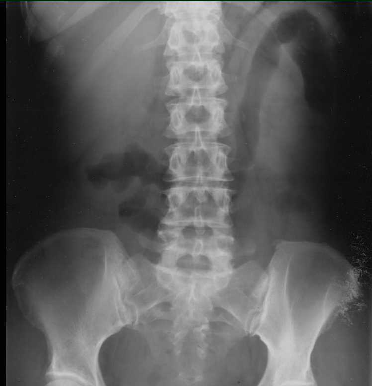 Featureless Colon in Ulcerative Colitis - CTisus CT Scan