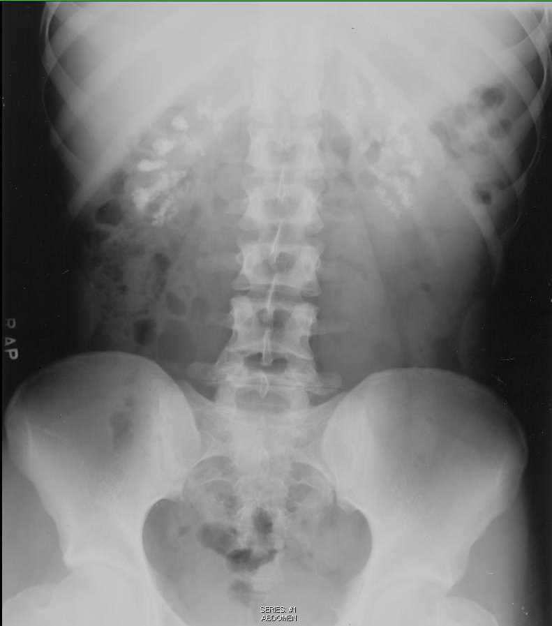 Nephrocalcinosis - CTisus CT Scan