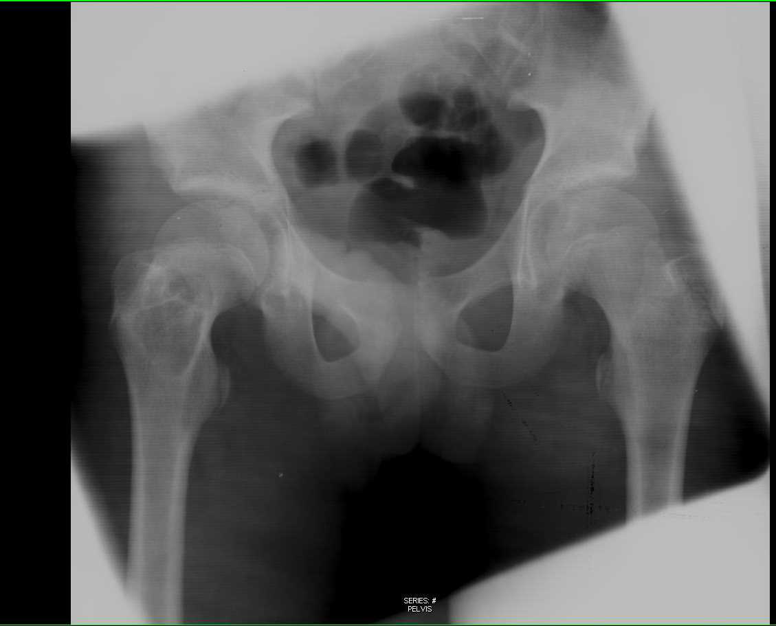 Simple Bone Cyst Right Femur - CTisus CT Scan