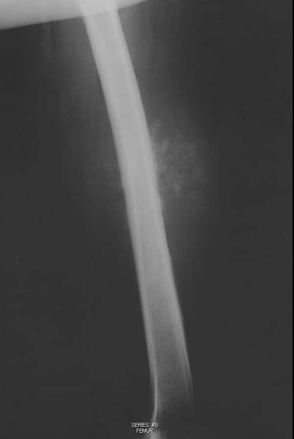 Periosteal Osteosarcoma, Femur - CTisus CT Scan