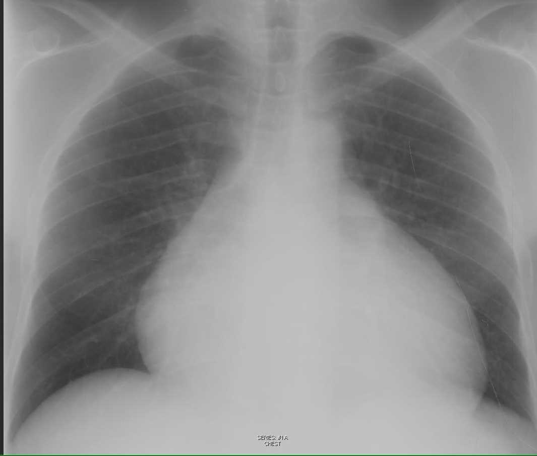Pericardial Effusion on Chest X-ray - CTisus CT Scan