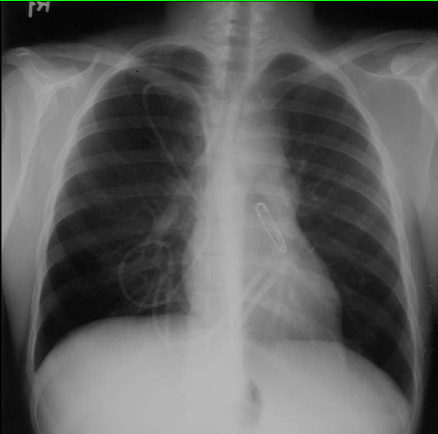 Lymphoma on Chest X-ray - CTisus CT Scan