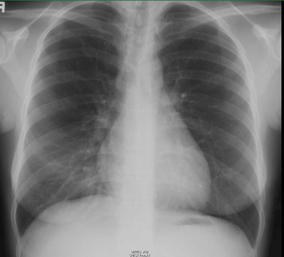 Right Middle Lobe Atelectasis - CTisus CT Scan