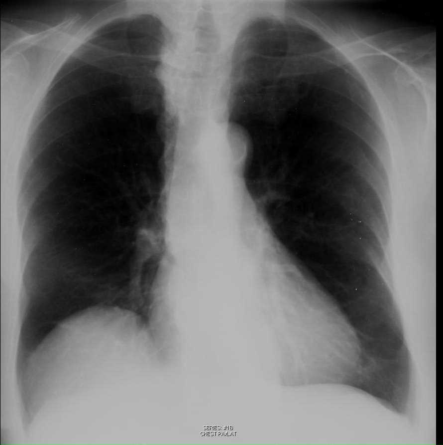 Coronary Calcification on Chest X-ray - CTisus CT Scan