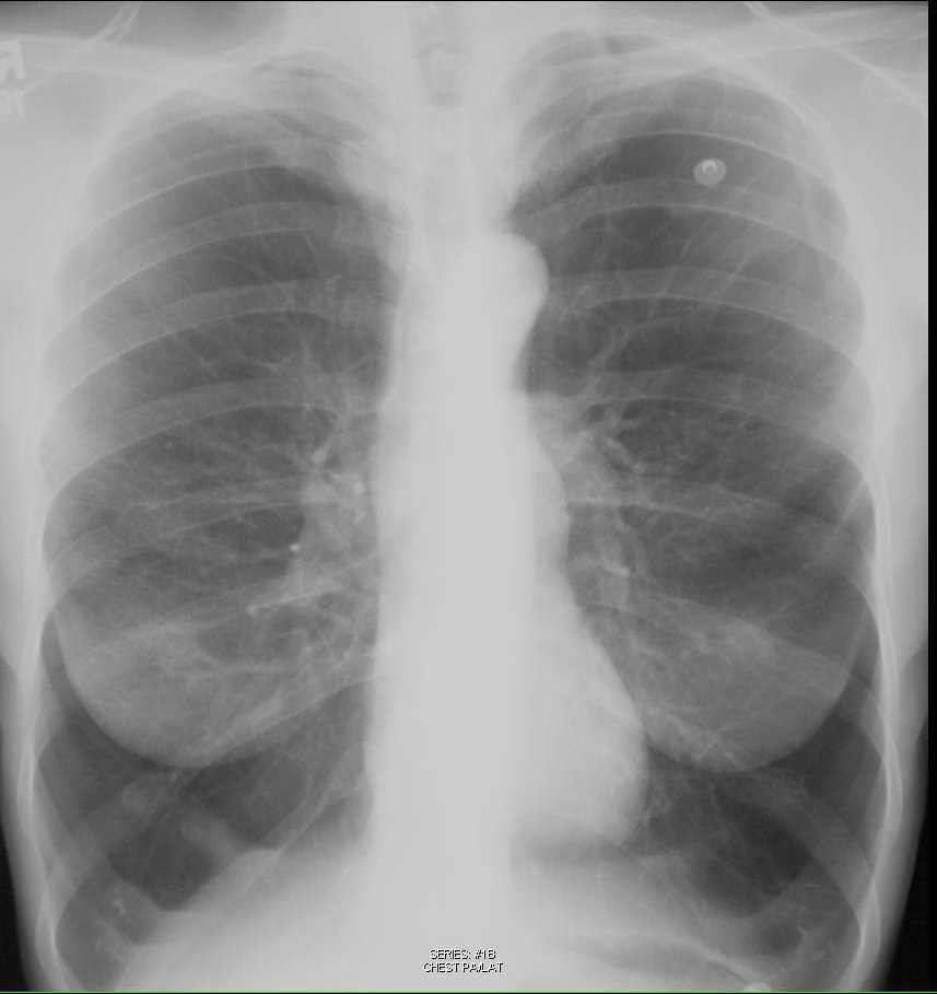 Emphysema on Chest X-ray - CTisus CT Scan