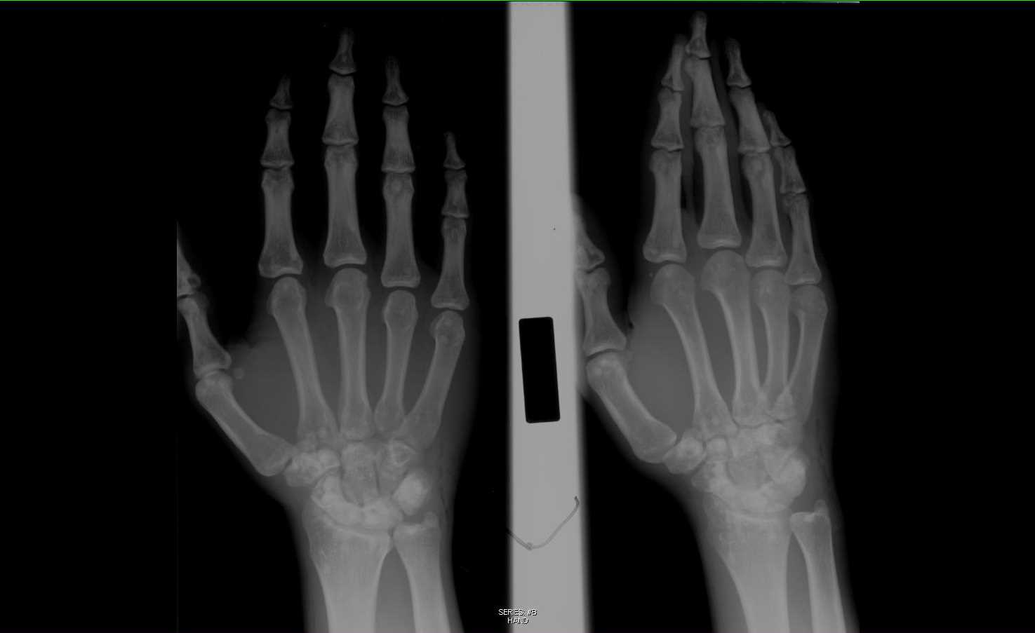 Osteopoikilosis - CTisus CT Scan