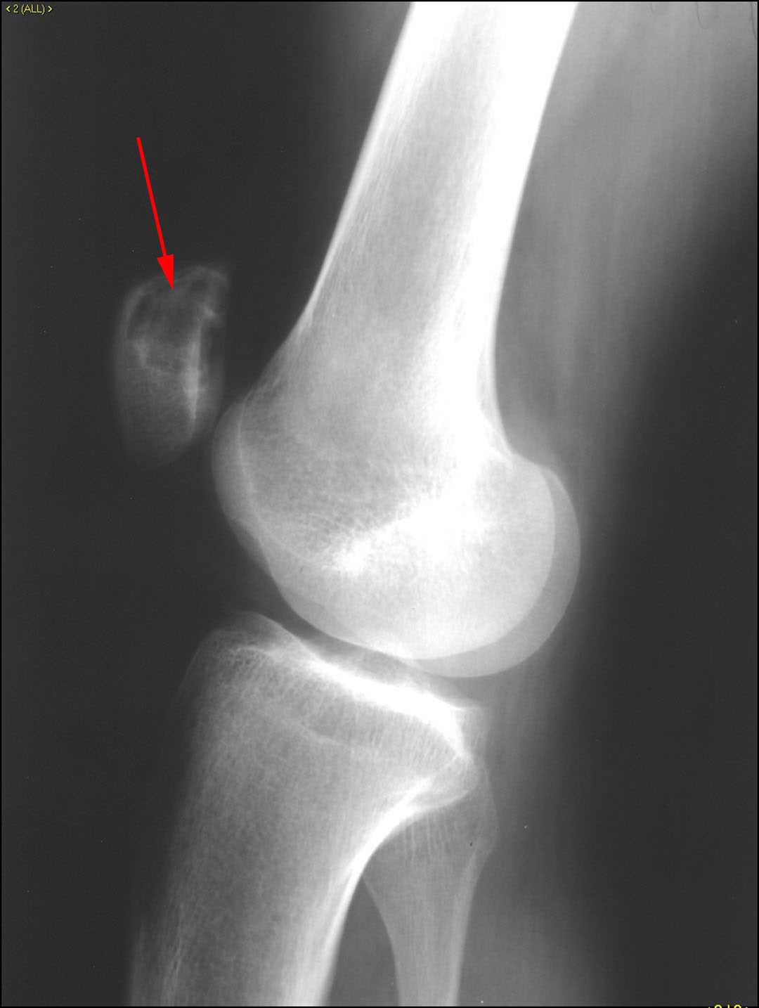 Chondroblastoma patella - CTisus CT Scan