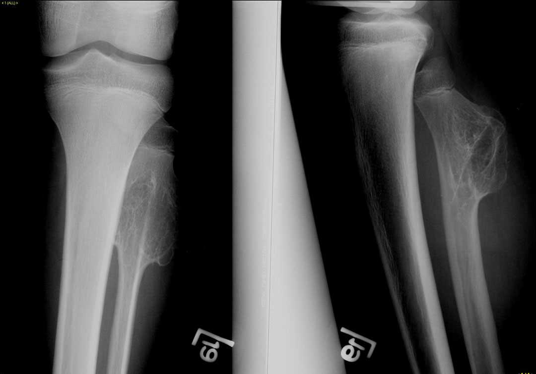Osteochondroma of the fibula - CTisus CT Scan
