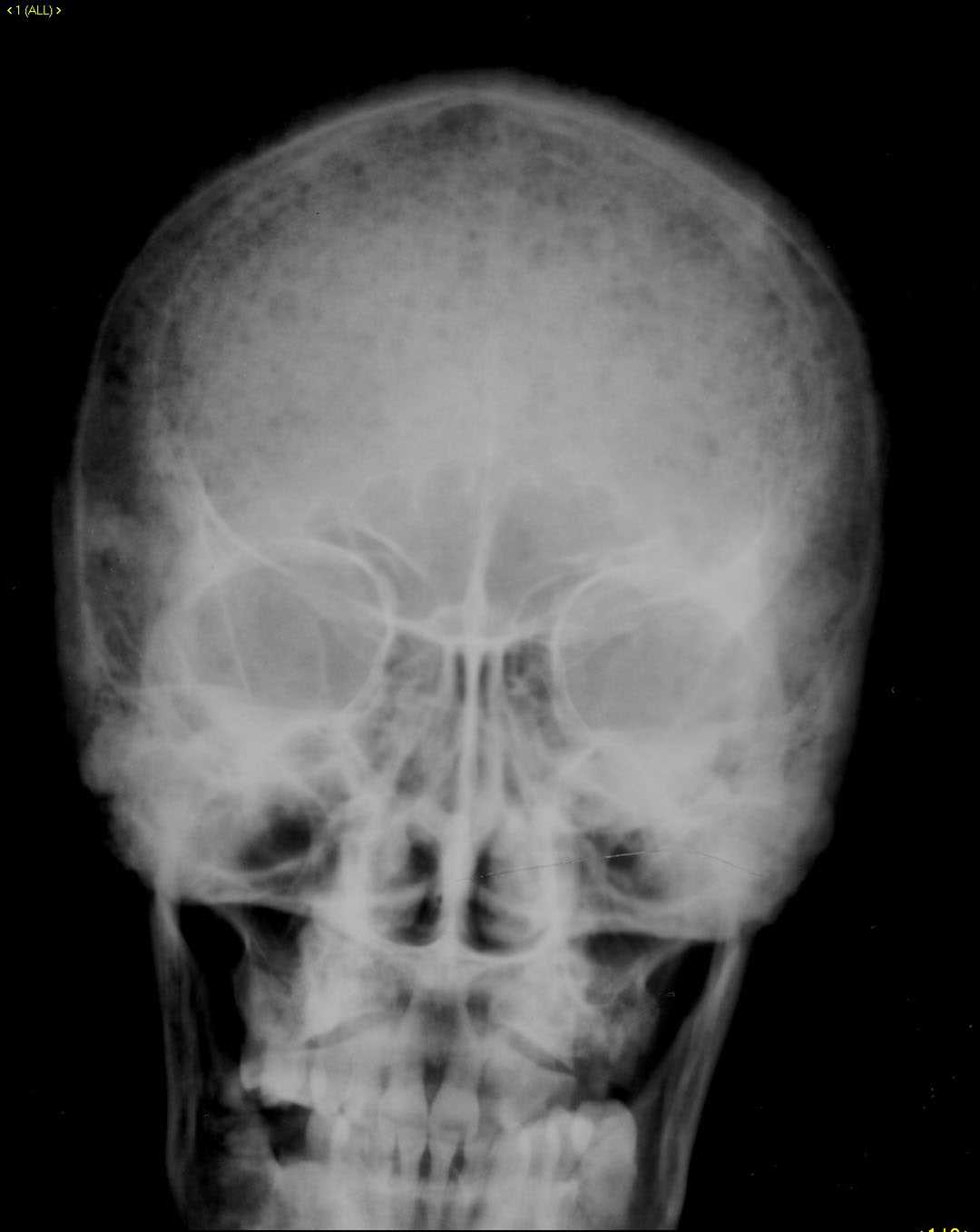 Multiple myeloma - CTisus CT Scan