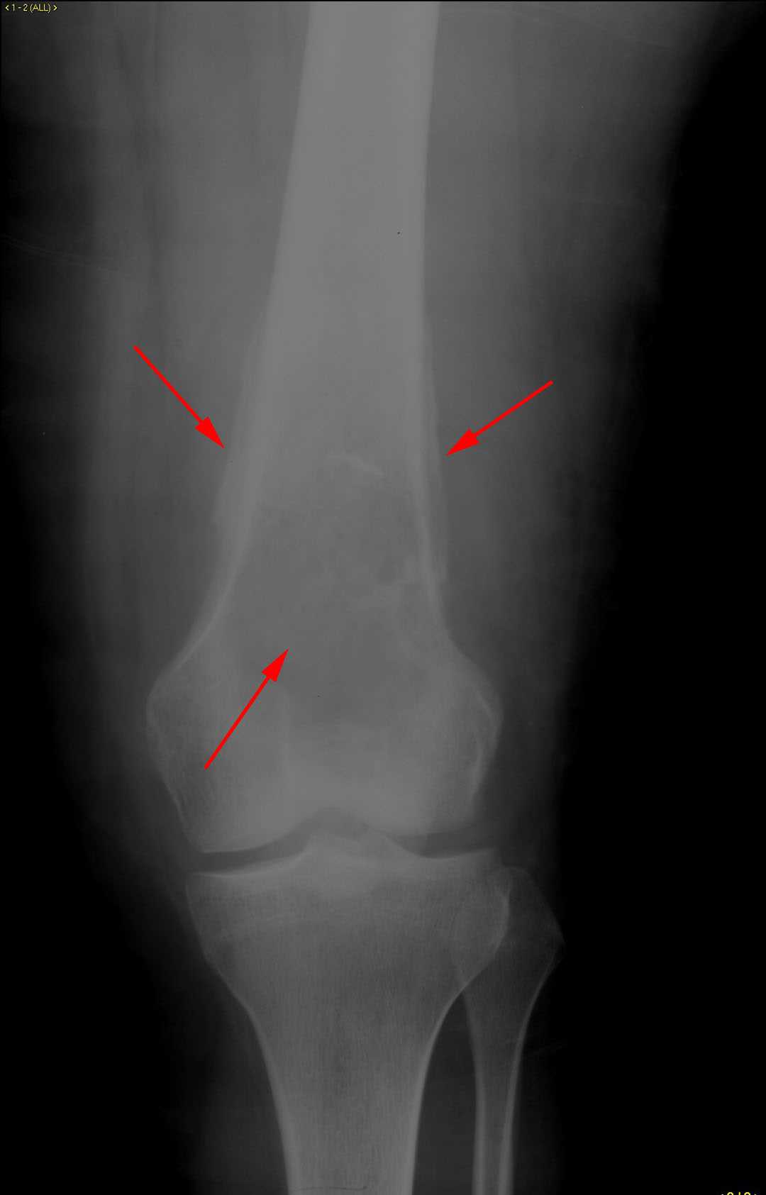 Osteosarcoma of the femur - CTisus CT Scan