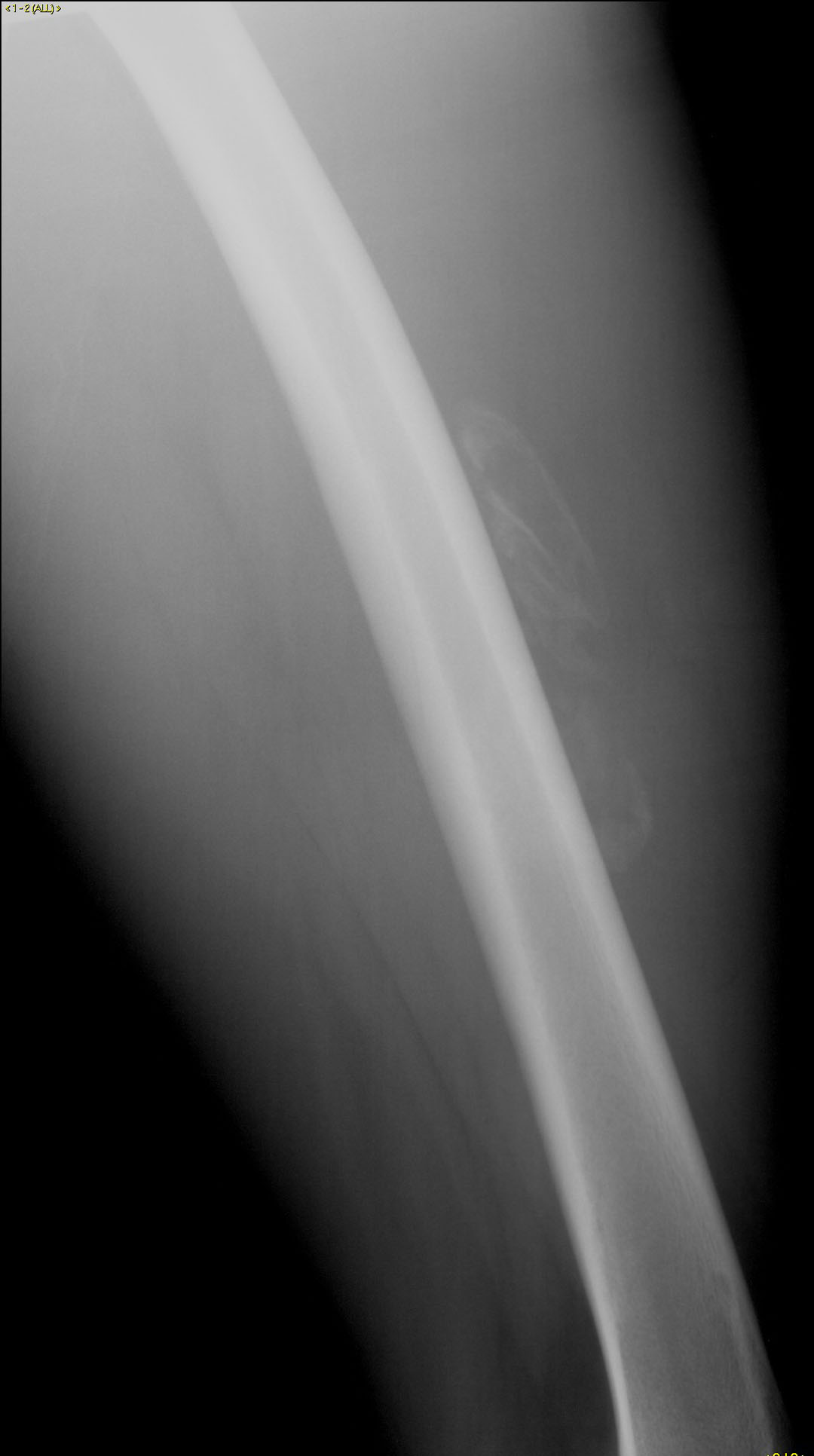 Myositis ossificans - CTisus CT Scan