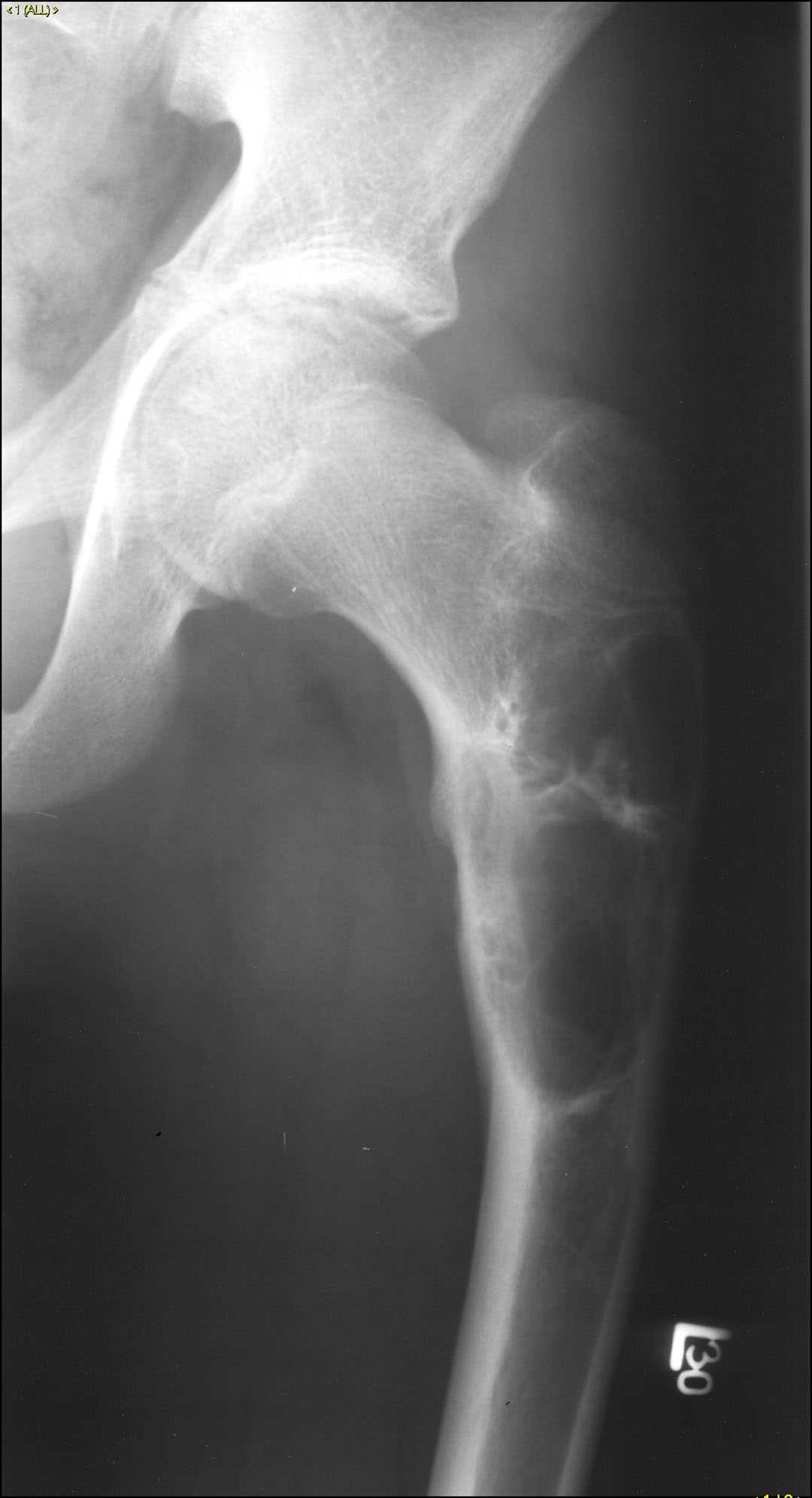 Unicameral bone cyst - CTisus CT Scan