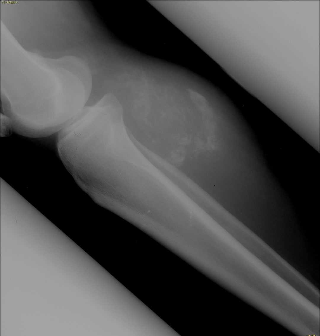 Synovial sarcoma - CTisus CT Scan